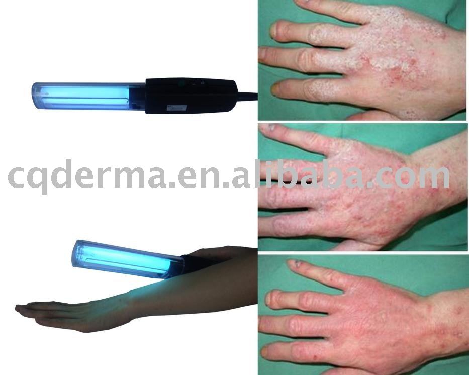 Does Ketoconazole Treat Eczema | there can be Tanning Eliminate Eczema